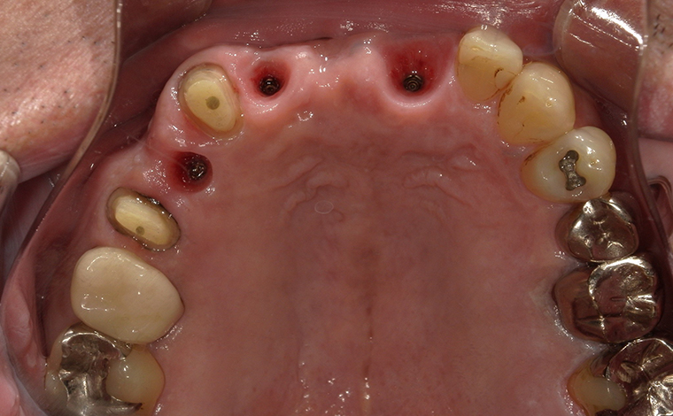 インプラント（前歯部）
