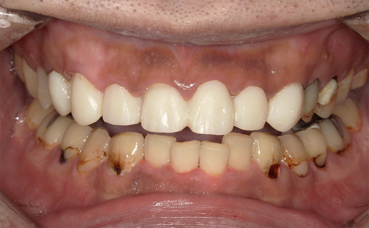 前歯部セラミック治療