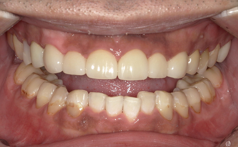 前歯部セラミック治療