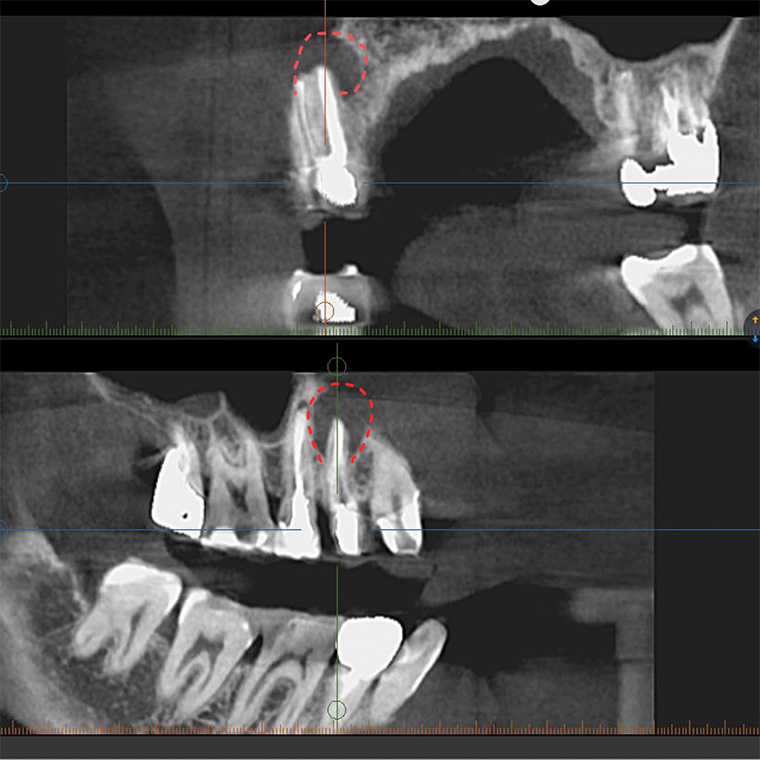 根管治療＋歯根端切除術